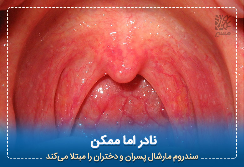 بروز علائم در دهان راهی برای تشخیص و درمان تب مارشال|مسیر