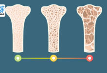 مراحل ایجاد پوکی استخوان اولیه|مسیر