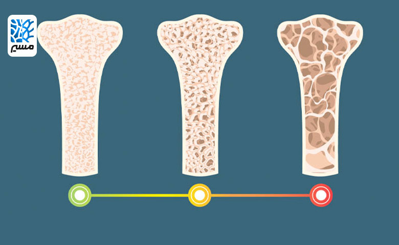مراحل ایجاد پوکی استخوان اولیه|مسیر