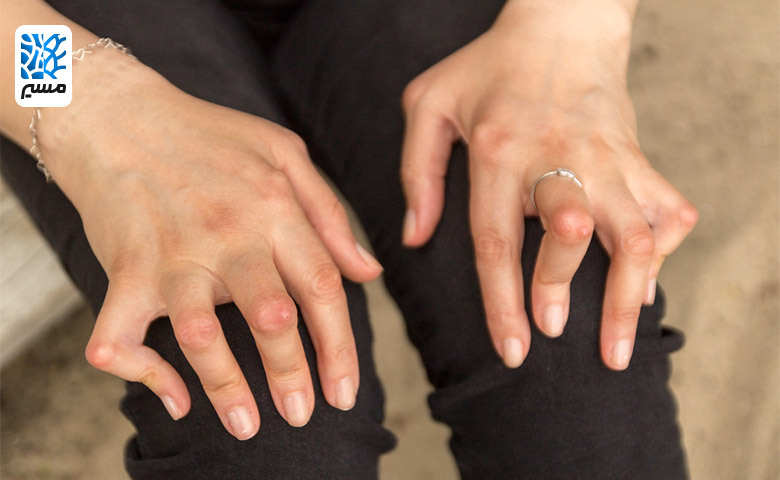 ایجاد بدشکلی در دست‌ها یکی از علائم روماتیسم مفصلی است|مسیر