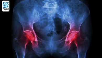 التهاب مفصل لگن یک درد آزاردهنده|مسیر