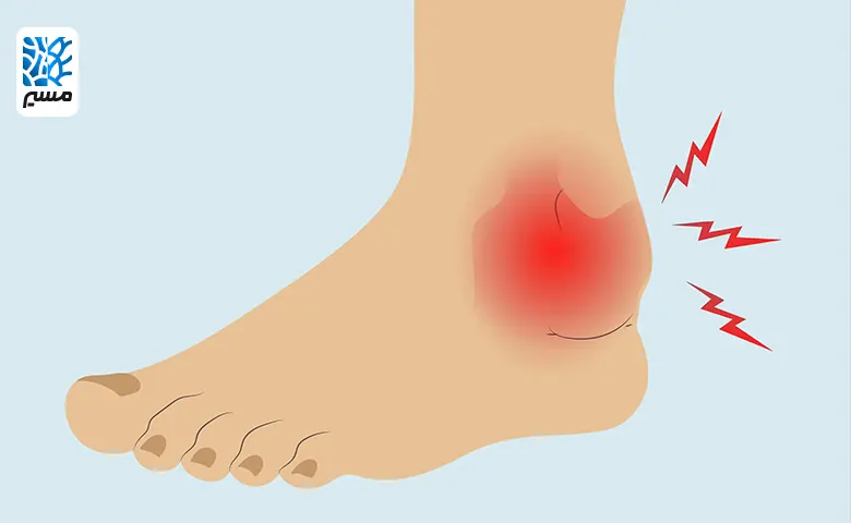 التهاب مفصل پا یک عارضه شایع|مسیر