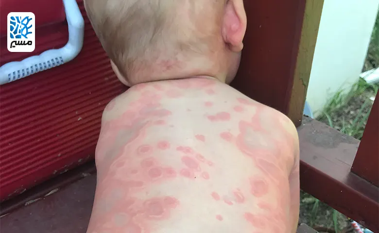 علائم بیماری سرمی روی پوست کودک|مسیر